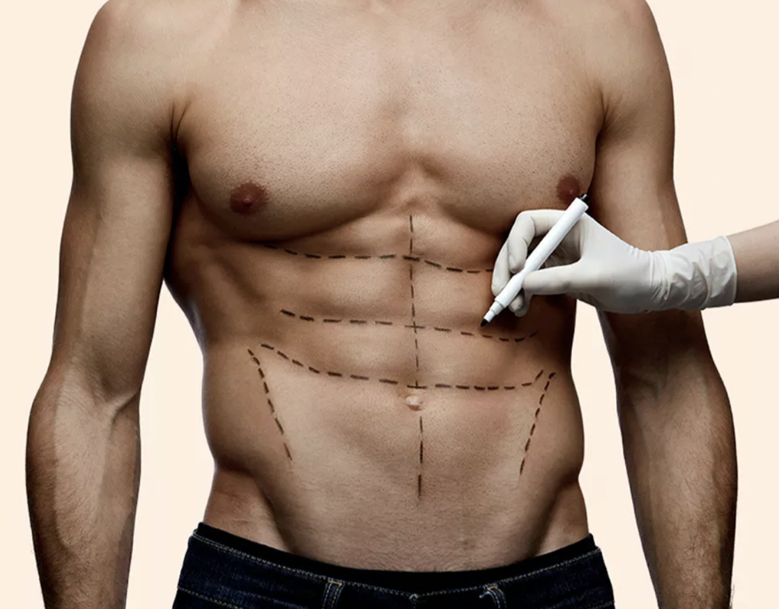 Abdominal Etching