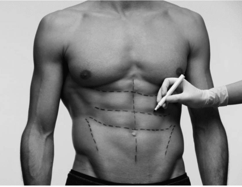 Homme athlétique — liposculpture VASER HD